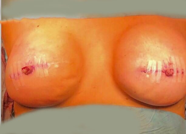 I need a mastectomy - should I have a reconstruction? - Sascha Dua Breast Surgeon