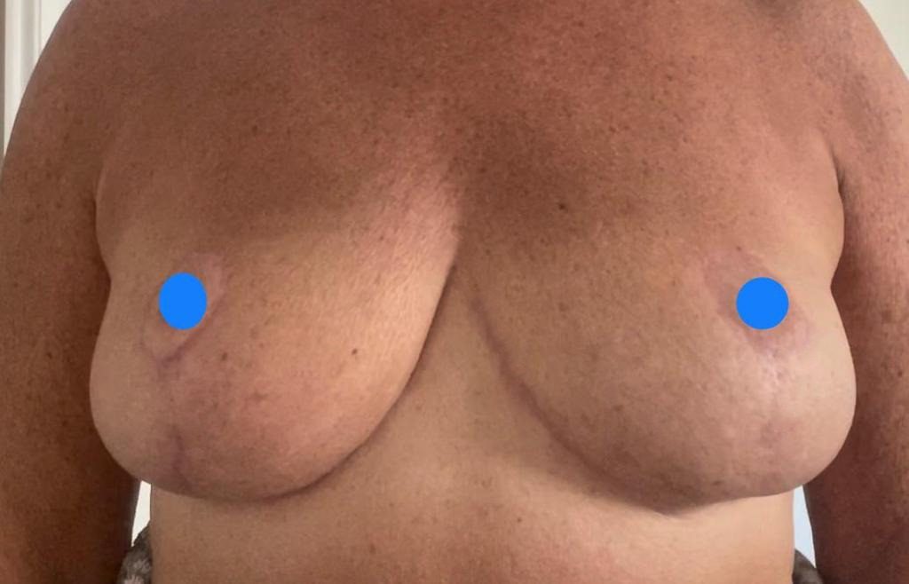 Before and After - Sascha Dua Breast Surgeon