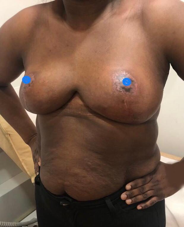 Before and After - Sascha Dua Breast Surgeon