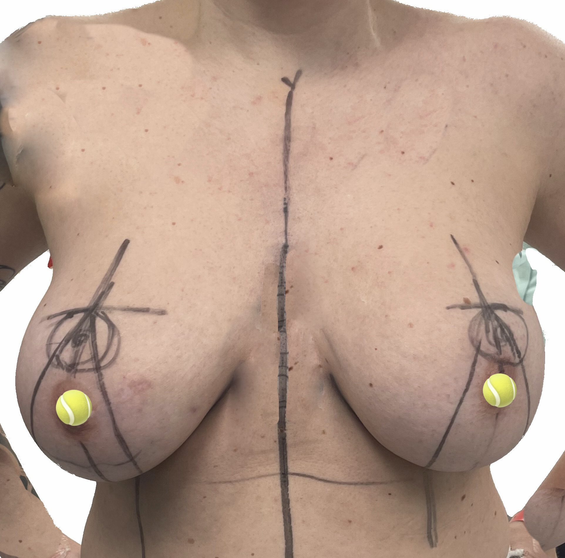 Before and After - Sascha Dua Breast Surgeon